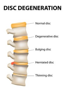 Disc Degeneration